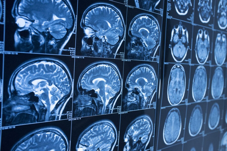 What Is a Coup-Contrecoup Brain Injury?