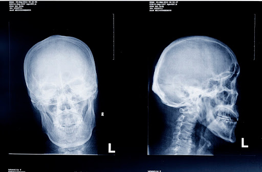While X-rays like these do not necessarily show brain injuries, they can show skull fractures from penetrating injuries. Big insurance companies may require extensive evidence to prove these kinds of claims.