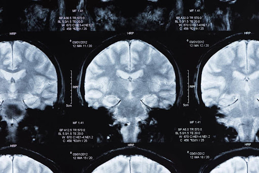 A magnetic resonance image stemming from a traumatic brain injury lawsuit.
